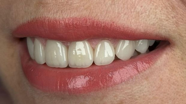 Ankara’da diş implantı talebinde gözle görülür artış - Resim : 1