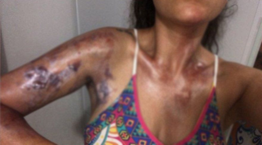 Düdüklü tencere patladı Sinem Umaş'ın kolları yandı! - Sayfa 3