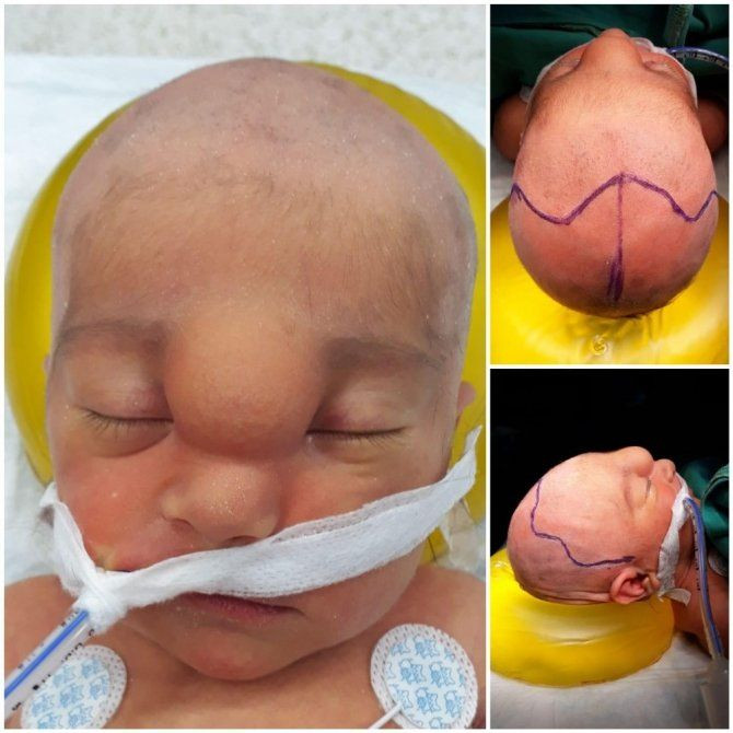 Yaşamaz denilen Buğlem bebek hayata tutundu F5Haber